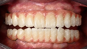 最新の会社の事例について 4Dジルコニアブロック