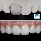 6 Layer Multilayer Dental Zirconia Block For Aesthetic Restoration