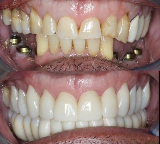 Yucera 4D Pro Dental - HT Plus テクノロジーによる修復物の品質を向上させる特殊ジルコニアセラミックブロック